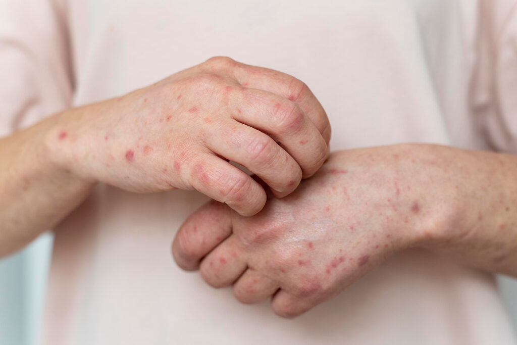 Monkeypox Risks: Symptoms and How to Stay Protected