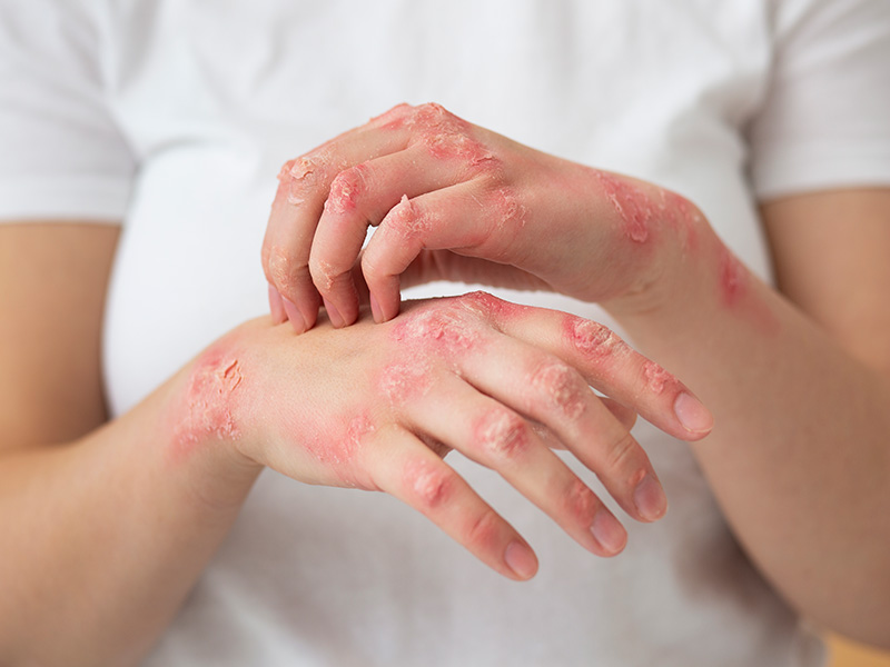 Monkey-Pox-2